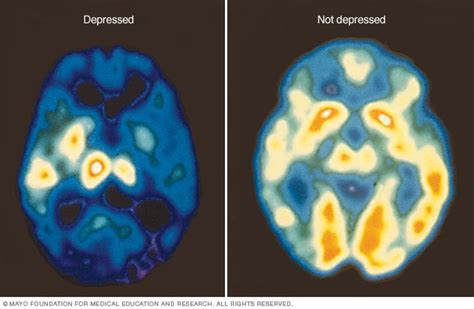 PET scan of the brain for depression - Mayo Clinic