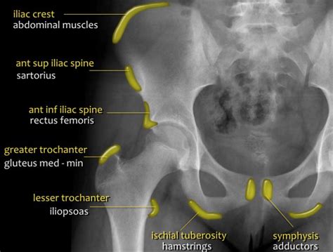 The Radiology Assistant : Hip pathology in Children