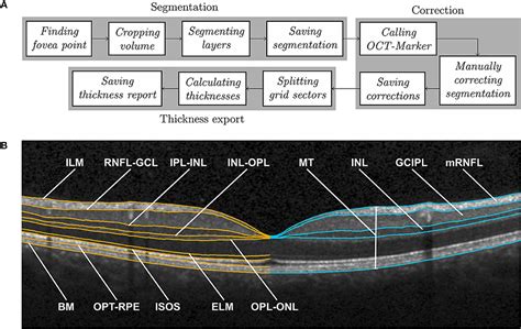 Oct Retinal Layers Labeled