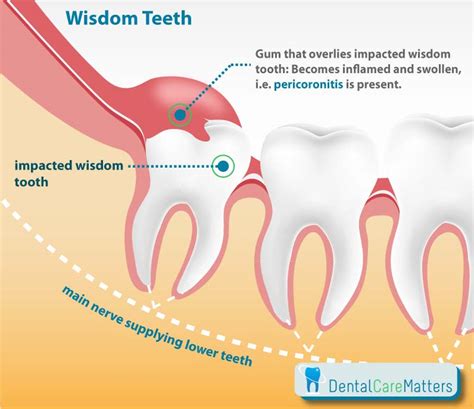 Wisdom Teeth Pain and Common Symptoms That Arise