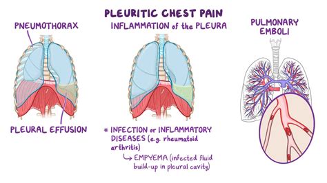 Pleurisy: What Is It, Causes, Symptoms, and More | Osmosis