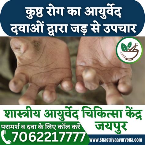 Leprosy Treatment Service at ₹ 1000/session in Jaipur | ID: 2852149068197