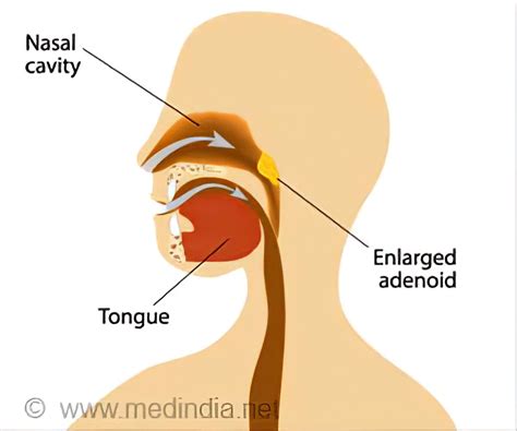 Adenoid Nose