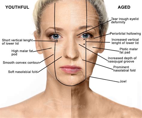 Cosmetic Mid-Face Lift | soof lift | face lift | lower eyelid blepharoplasty