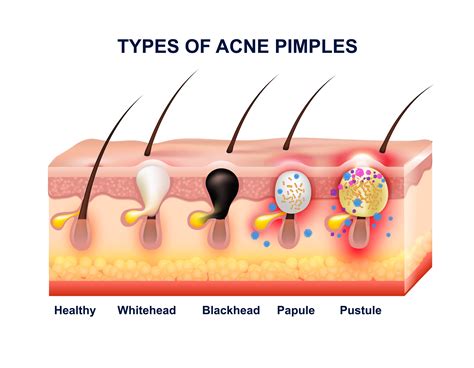 Skin Acne Types Diagram Vector Skin Problems Disease Pimples | The Best ...