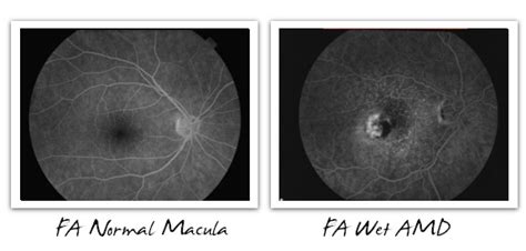 Dry & Wet AMD - Signs, Symptoms, and Diagnosis - Cure AMD Foundation