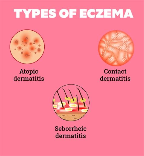 All You Need to Know About Eczema on Face | Be Beautiful India