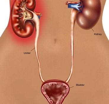 Pyelonephritis - Health Tips, Pyelonephritis Health Articles, Health News | TheHealthSite.com