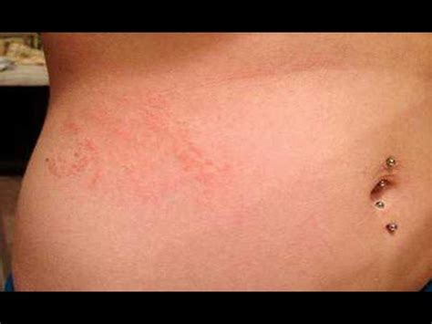 scabies rash image - pictures, photos