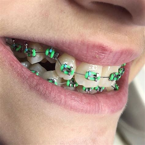 Best Braces Colors For Boys To Wear To Appeal To Girls | Braces Explained