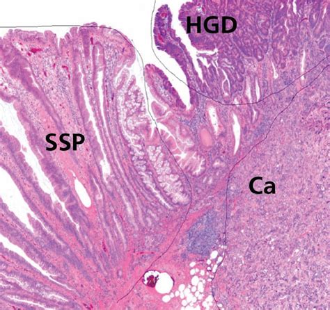 Sessile Polyp Histology