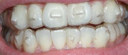 Invisalign Attachments | Riviera Orthodontics