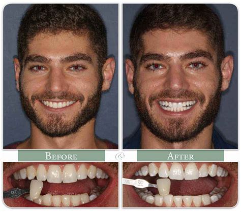 Smoking Teeth Before And After