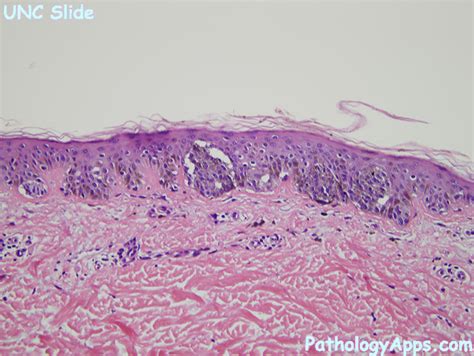 Junctional Nevus Histology