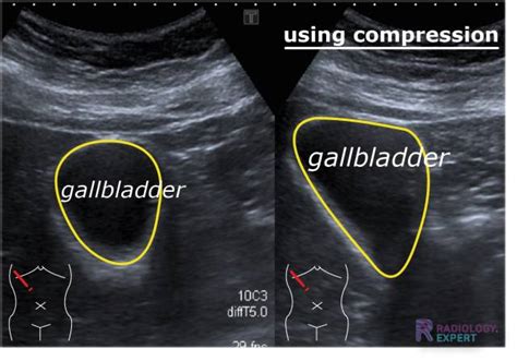 Abdominal ultrasound