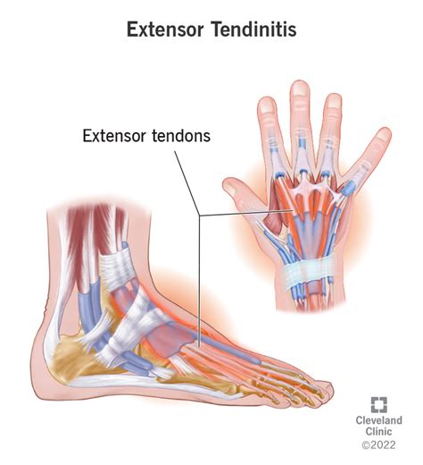 Tendonitis Foot Sale | cityofclovis.org