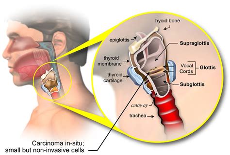 Staging of Laryngeal Cancer - American Head & Neck Society