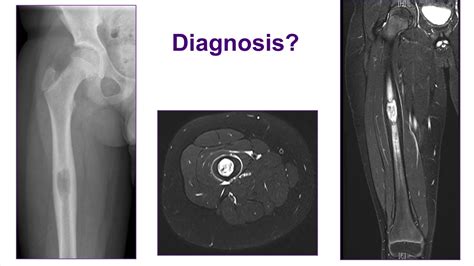 Benign Bone Tumors - ABOS Orthopedic Surgery Board Exam Review - YouTube