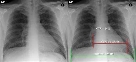 Chest X-ray - Quality - AP v PA chest X-rays