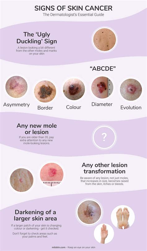 Skin Cancer Symptoms Pictures Photos Types Signs Melanoma - Riset