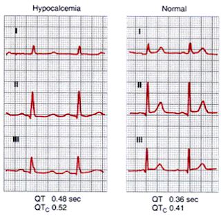 Hypocalcemia And Ecg Changes