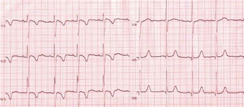 velocità sirena Indebolire inverted t wave ecg divario Spazio ...