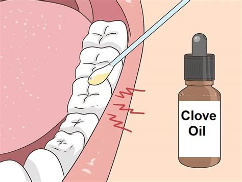 Can I use clove oil to relieve toothache? | News | Dentagama