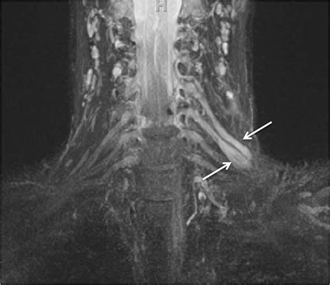 Anatomy - Brachial Plexus | Geeky Medics