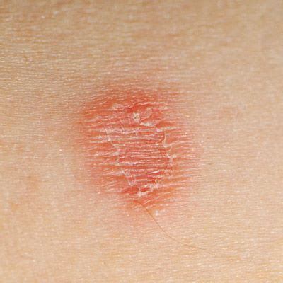 10 Diabetic Skin Conditions: Rash, Sores, and Blisters | Everyday Health