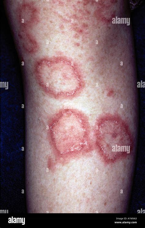 lupus skin rash Stock Photo: 3361442 - Alamy