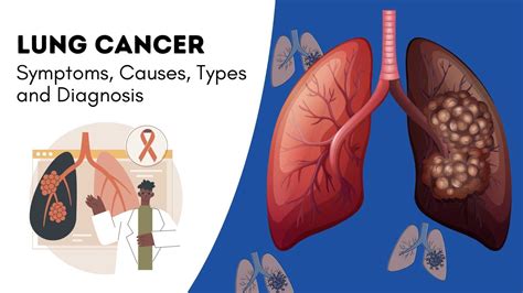 Lung Cancer: Symptoms, Causes, Types and Diagnosis | Sprint Medical