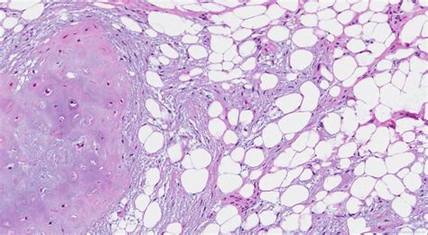 Hamartoma of the lung | Ottawa Atlas of Pathology