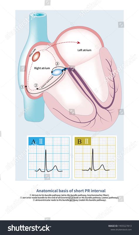 Part Short Pr Interval Ecg Enhanced Stock Illustration 1955527813 | Shutterstock