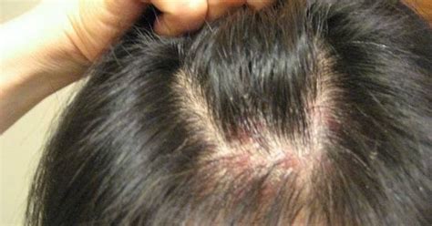 Treating Scalp Psoriasis Without Having A Hair Loss