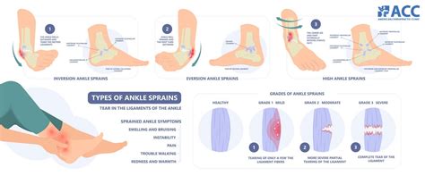 Ankle pain: Causes and Treatments | ACC