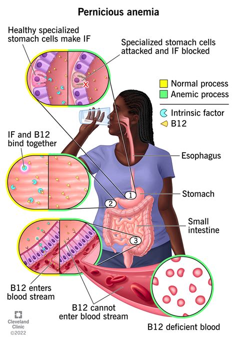 How To Diagnose Pernicious Anemia - Riseband2