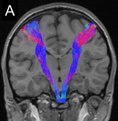 Corticospinal Tract - Physiopedia