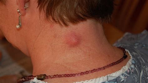 Epidermoid cyst: Symptoms, causes, treatment, and more