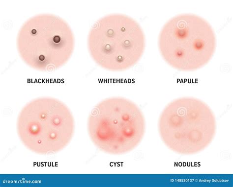 Skin Acne Types Diagram. Vector Skin Disease Pimples Blackheads and ...