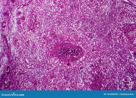 Renal Tuberculosis, Light Micrograph Stock Image - Image of cell ...