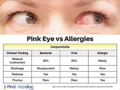 Pink Eye (Conjunctivitis): Symptoms, Causes, Treatment, and Diagnosis ...