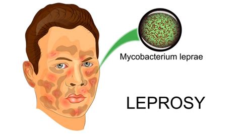 Leprosy - Symptoms, Treatment and More - Solution Parmacy