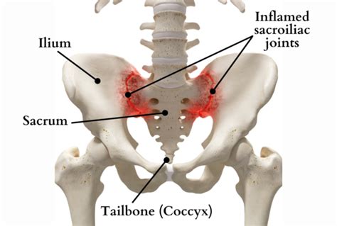 Sacral Bone Pain – Causes, Treatment, and Anatomy of Sacrum