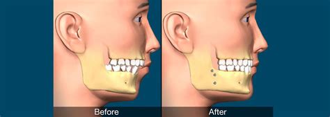 Corrective jaw surgery is performed as a solution to jaw and teeth misalignment. Following are ...