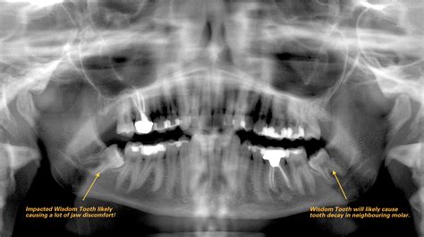 4 reasons why not to delay wisdom teeth removal