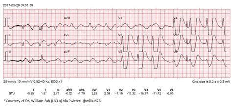 Sine Wave Hyperkalemia Ecg Changes