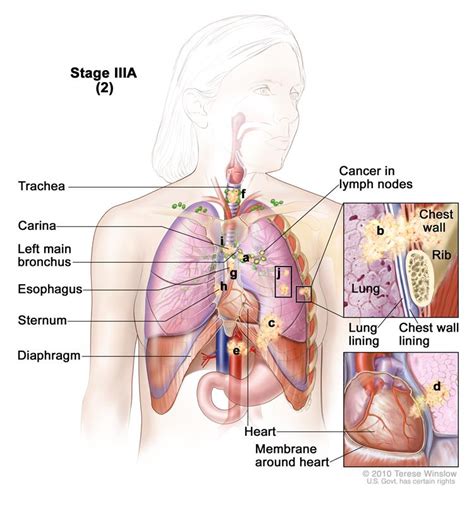 Stage IIIA lung cancer (2). Drawing shows cancer in the lymph nodes, trachea, carina, left main ...