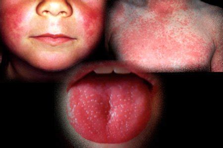 Scarlet fever symptoms in a child - Medical diagnosis