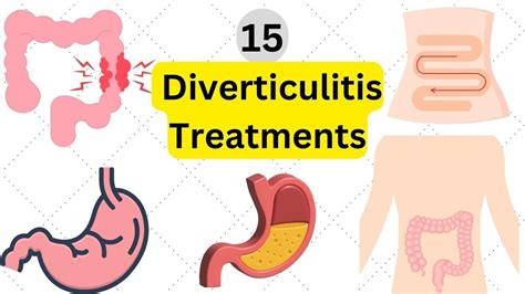 15 Diverticulitis treatments - less invasive treatment for ...