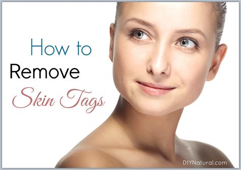 How to Remove Skin Tags Naturally?